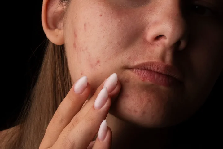 Zdjęcie przedstawia zbliżenie na cerę kobiety z problemami skórnymi